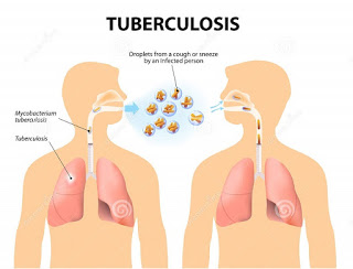 क्षयरोग रोगाविषयी माहिती